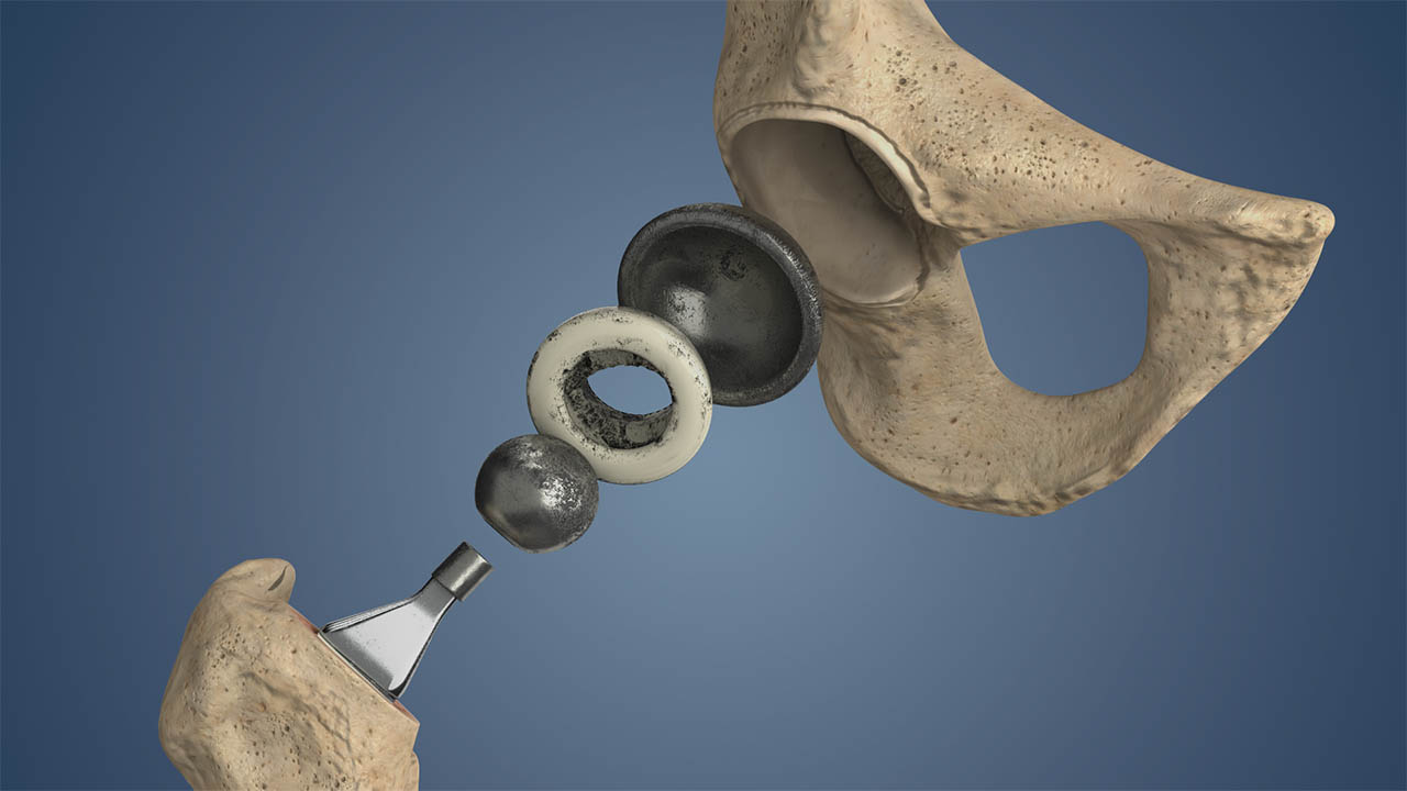 Ολική Αρθροπλαστική Ισχίου: Ο Πλήρης Οδηγός